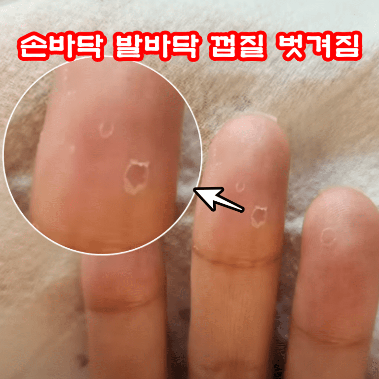 손바닥 발바닥 껍질 벗겨짐