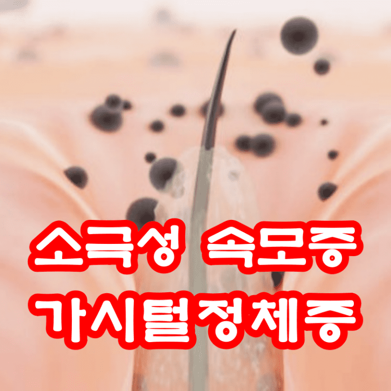 소극성 속모증 가시털정체증