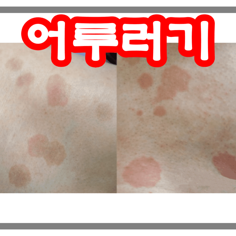 어루러기