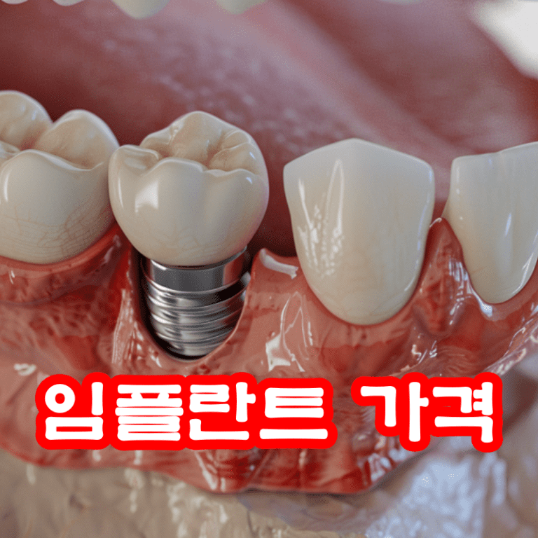 임플란트 가격